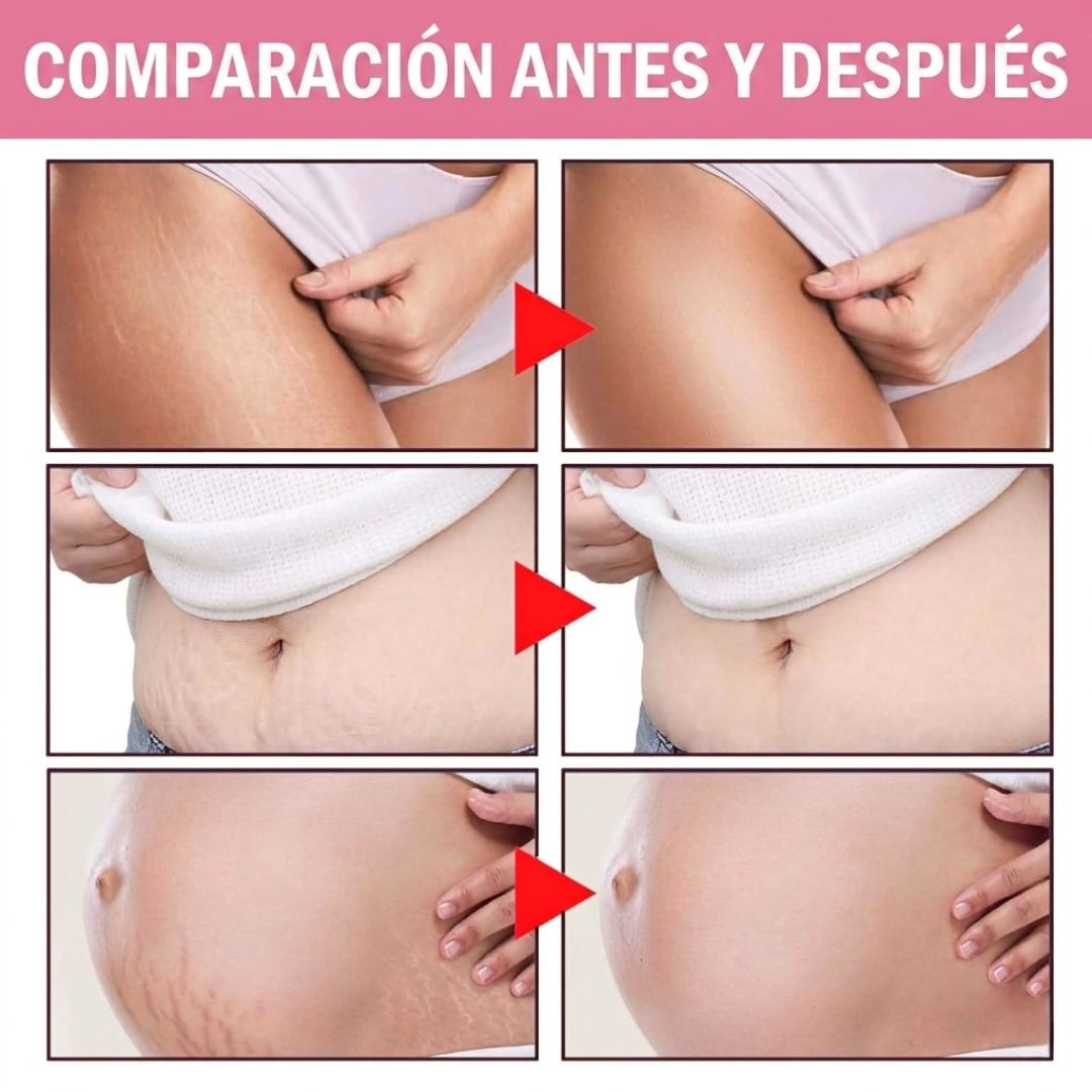 Adeus Crema Brasileña – Crema Rosa Anti-Estrías con Árnica, Jengibre, Cafeína y Té Verde – 300g