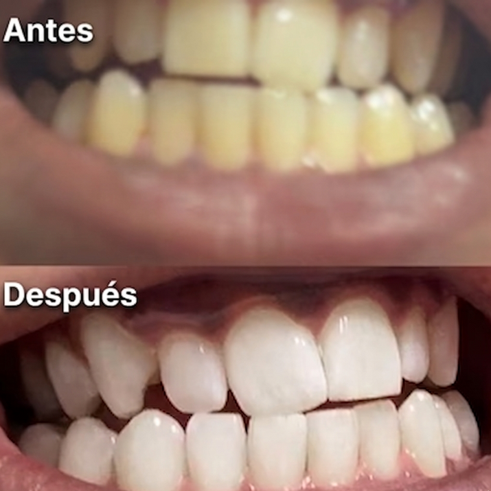 14 Tiras Blanqueadoras Dentales
